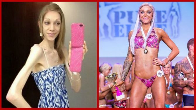 Woman Who Dropped To Four Stone Due To Anorexia Recovers To Become Champion Weightlifter