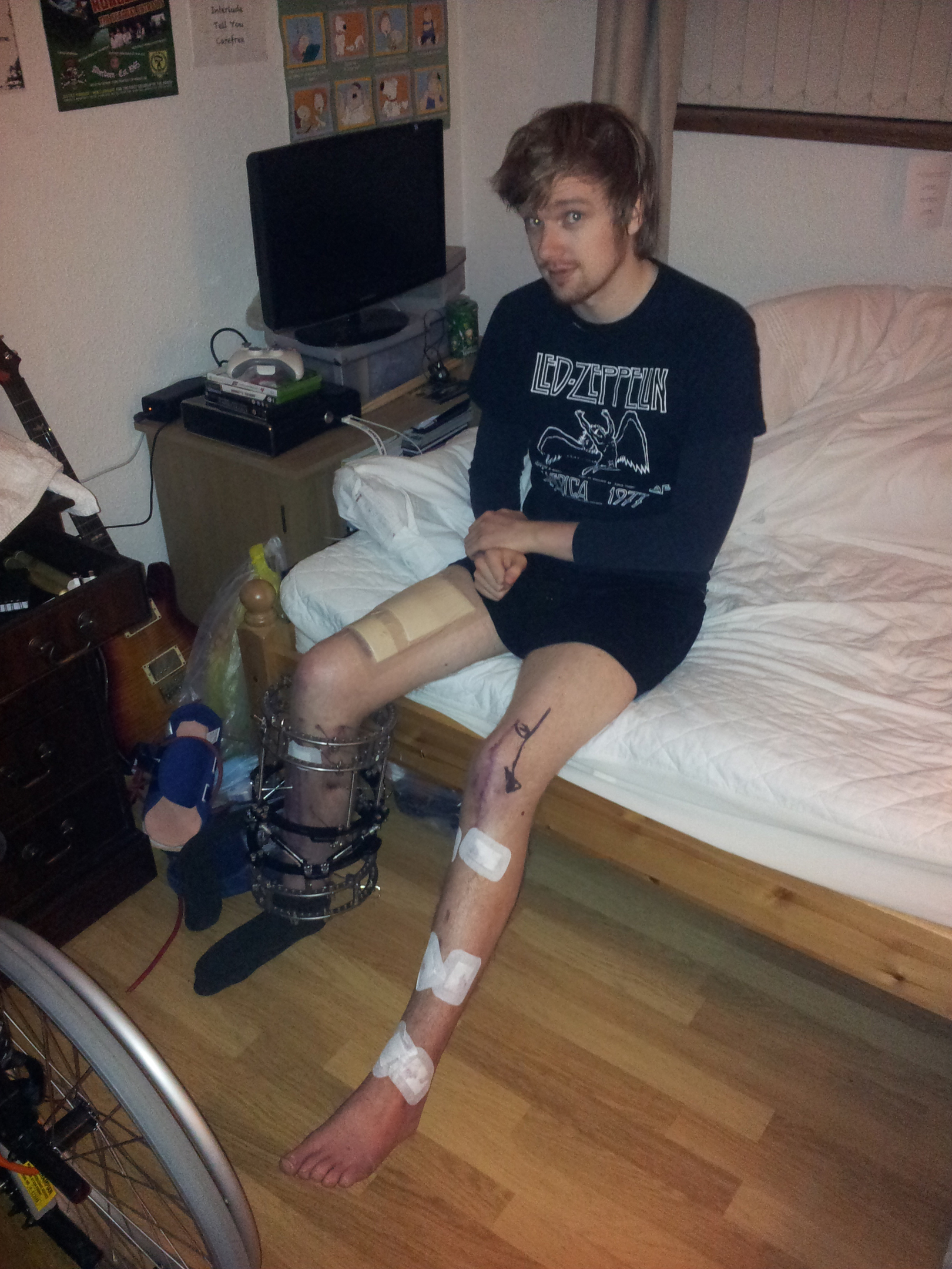 Dave eventually had to have his leg amputated.