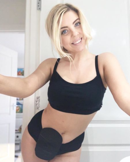 Samantha is challenging the stigma around stomas and raising awareness of inflammatory bowel disease.