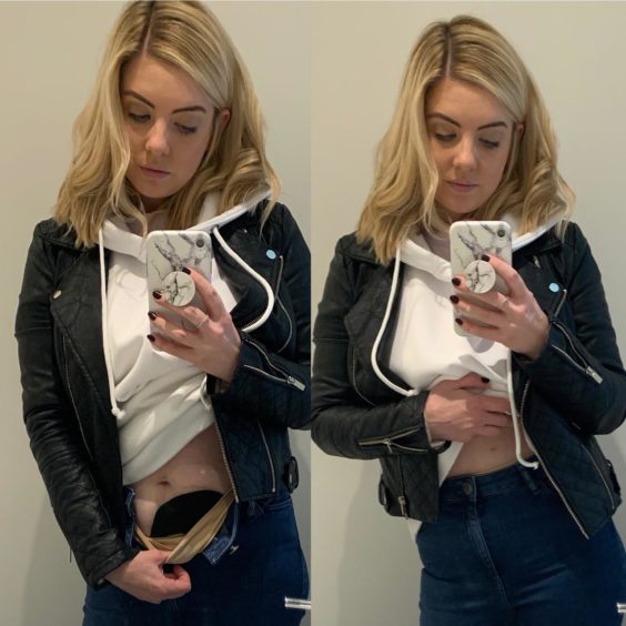 Samantha is keen to highlight that not all diseases are visible and can easily be hidden by clothing