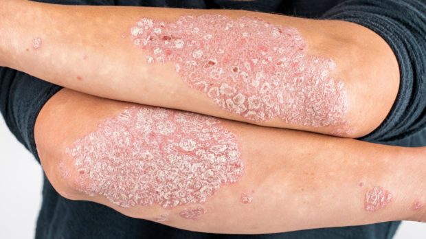Psoriasis Awareness Week starts on Thursday