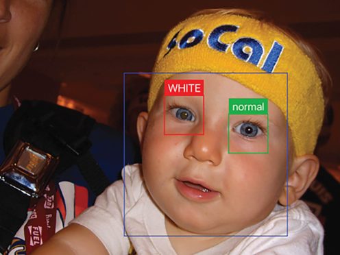 An example of leukocoria (Munson et al/Science Advances)