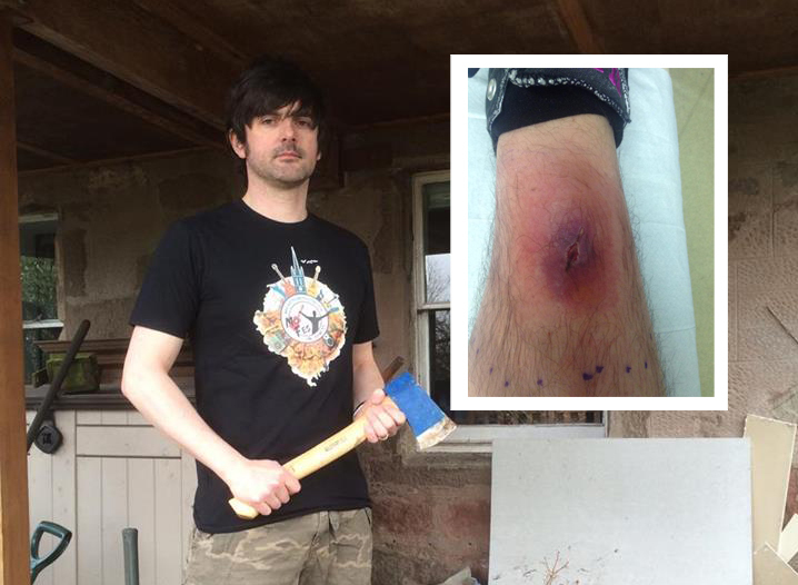 Man taken to hospital after ‘scary’ axe injury Evening Telegraph