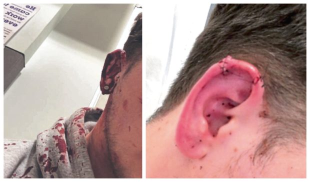 Cody needed 11 stitches to reattach the top of his ear after it was ripped off in an unprovoked attack.