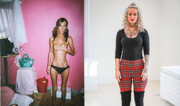 Natasha, left, at the height of her illness and, right, as she looks today.