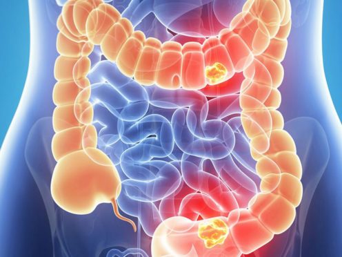 An image illustrating bowel cancer (Queen’s University Belfast/PA)