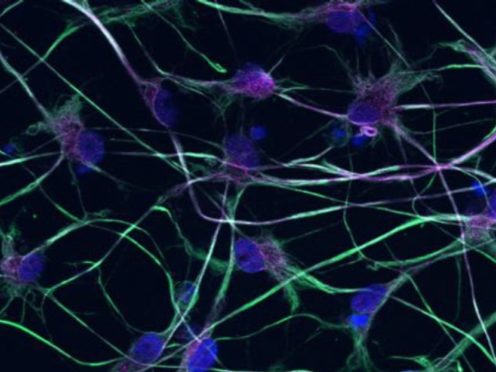 Glial cells under a microscope, said to be ‘key players’ in motor neurone disease (University of St Andrews/PA)