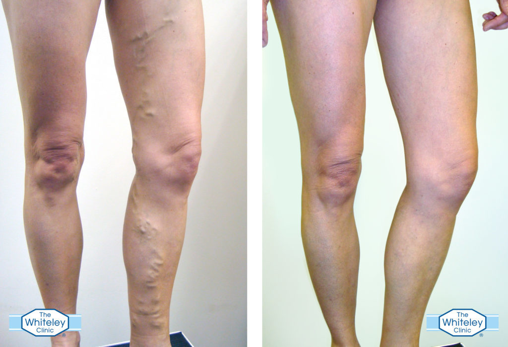 Before and after varicose vein surgery