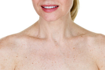 woman with age spots