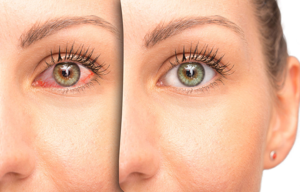 Red eye before and after use of eyewash;