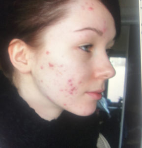 Adult Acne