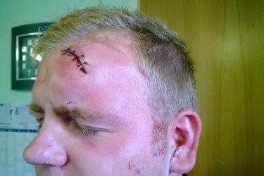 Callum Smith's injury