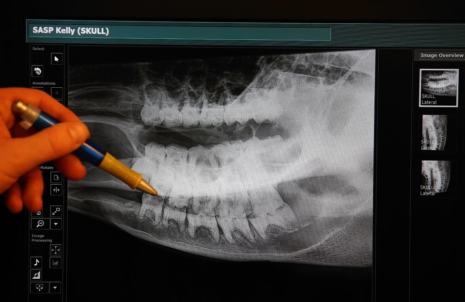 Vets examining an X-ray taken of Kelly the  giraffe's jaw 