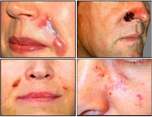 Botched operations can leave swelling sores on the patient's face
