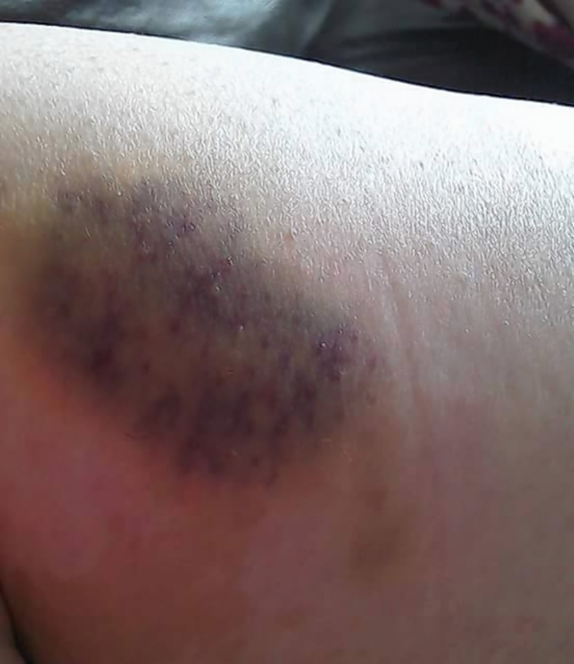 Ms Jamieson took photographic evidence of the bruises that Ross left her with 