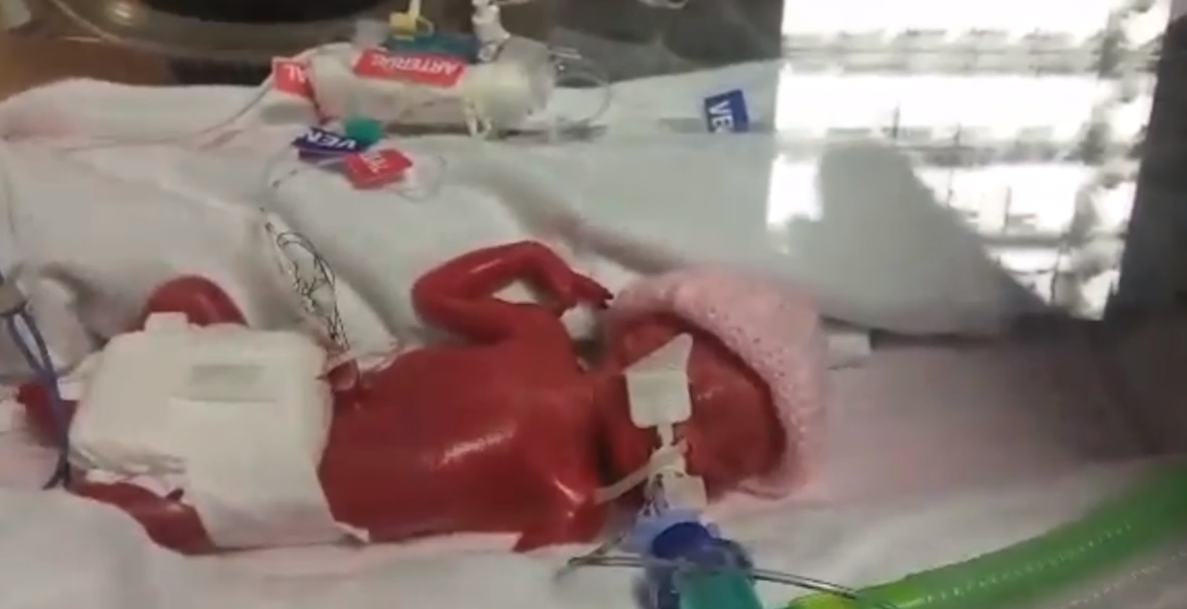 Miracle baby that was born FOUR MONTHS before her due date - and survived