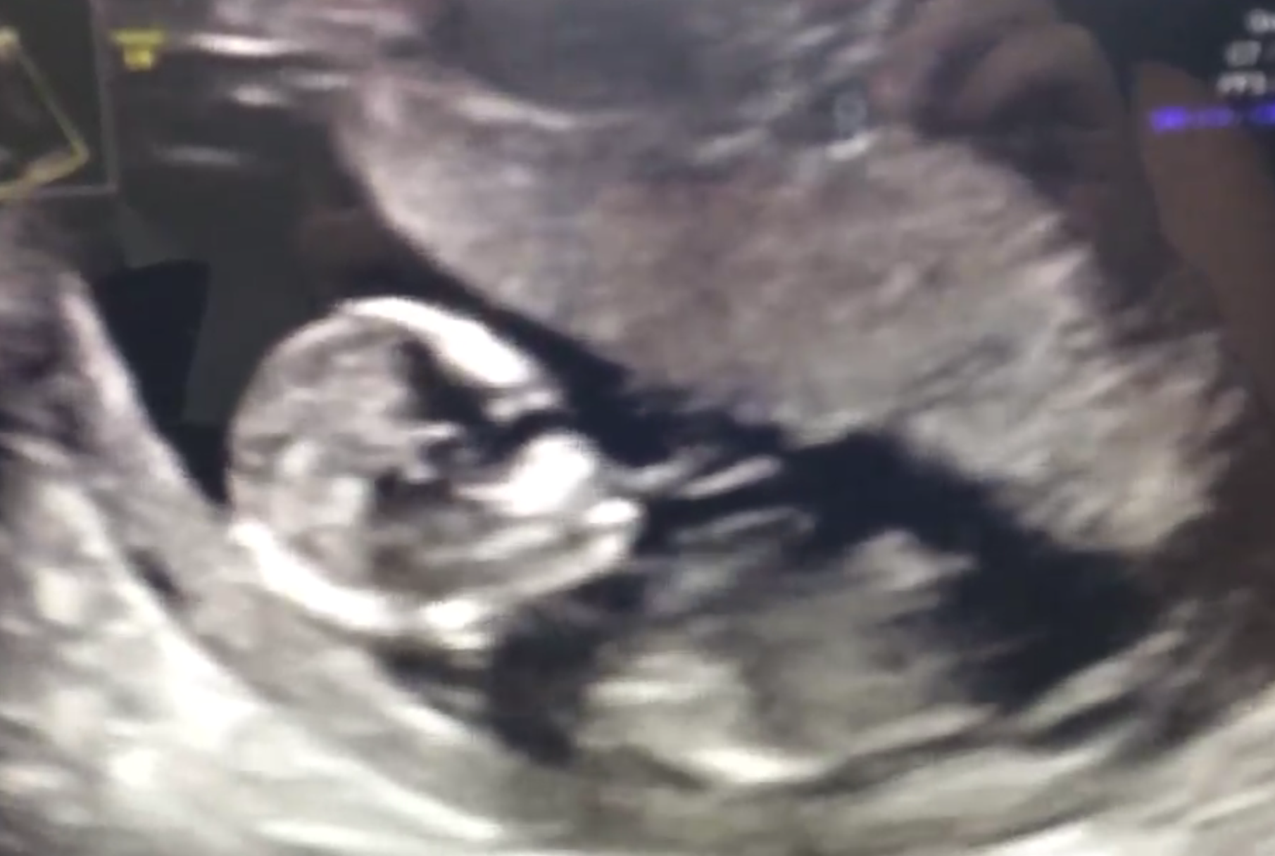 Sandi Thom's pregnancy scan