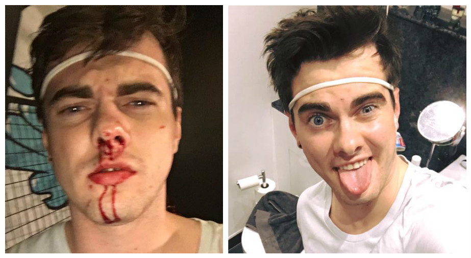 Alexander Lees before and after the alleged attack.