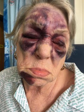 Jill Symmonds was left with horrific bruises across her face