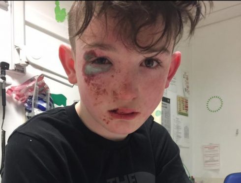 Shane Flower, 12, sustained serious burns to his face while out with his friend in Northfield.