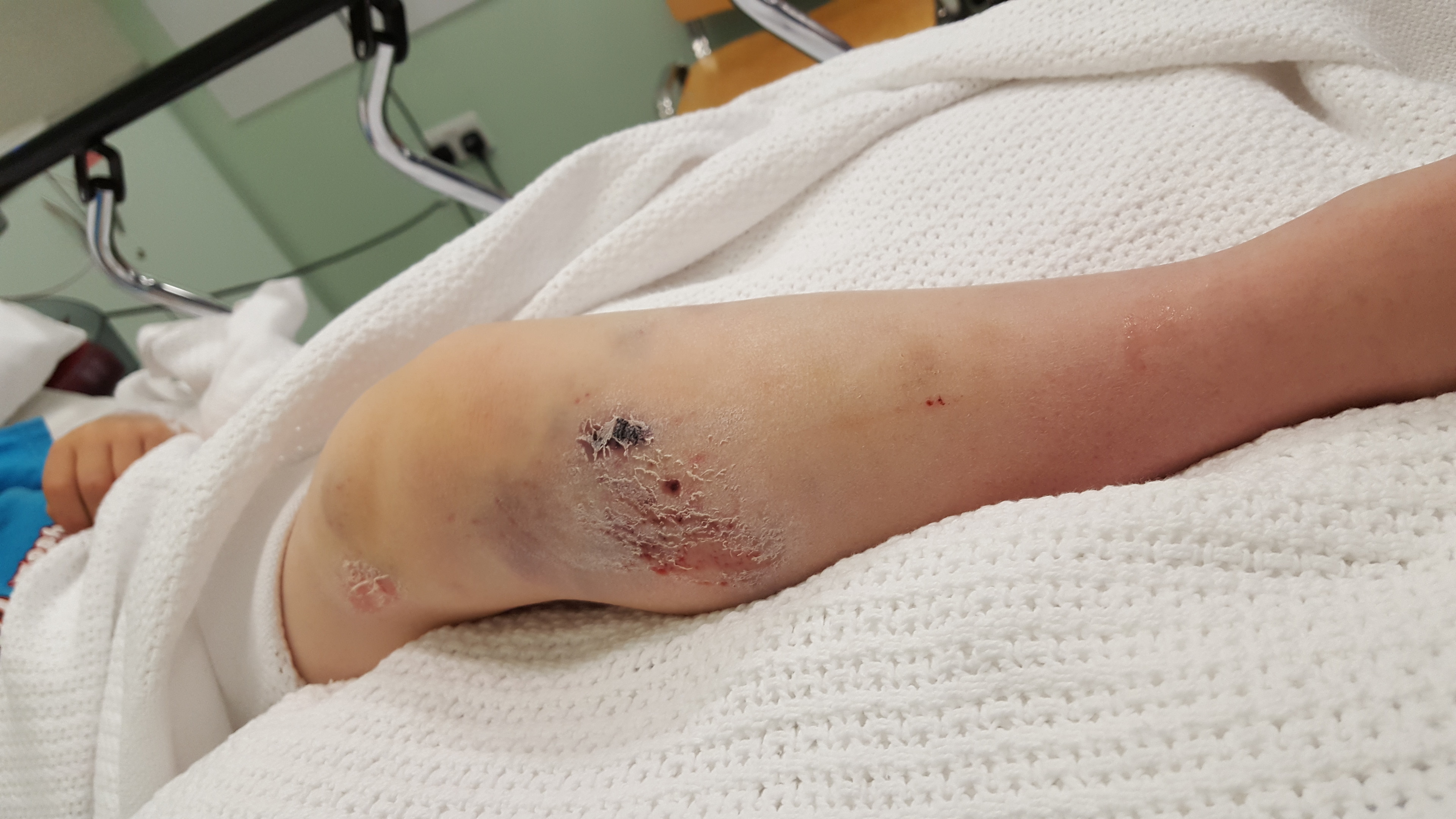 The injury to Max's leg after being crushed by a falling stone
