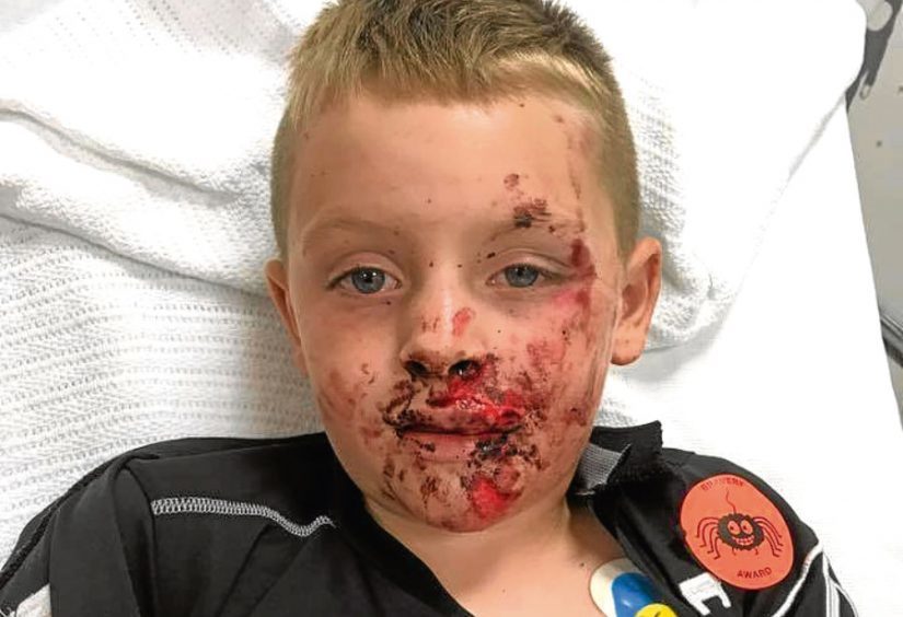 LJ Jackson, 8, suffered facial injuries after being hit by a moped.
