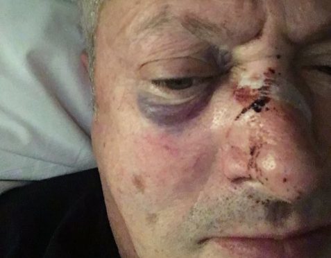 Nick Nairn shared this image of the injuries he sustained in the late night assault.