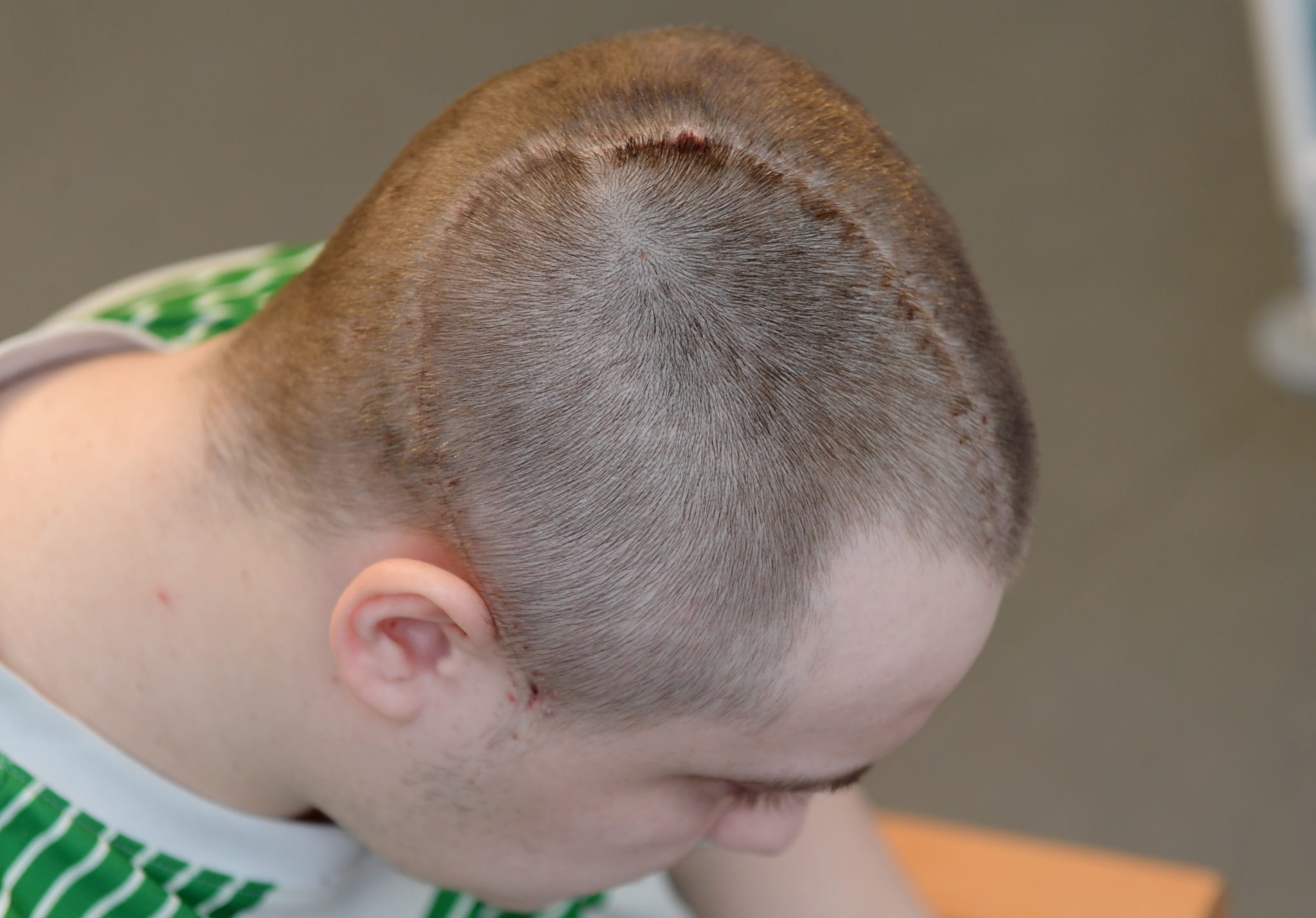 Chunk of skull removed from man after serious infection undetected by