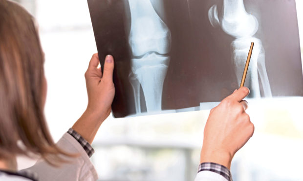 A doctor holding up an xray and seeing a leg or arm bone,