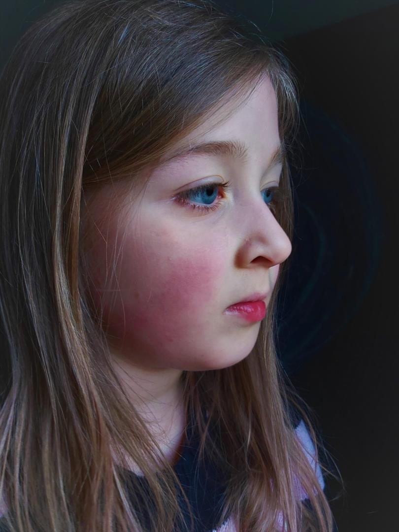 An angry rash appeared on Anna's face and body.