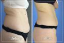 LPG Body Contouring: This patient had eight LPG Body Contouring sessions. She actually gained weight over the course of treatment and yet still achieved these amazing results.