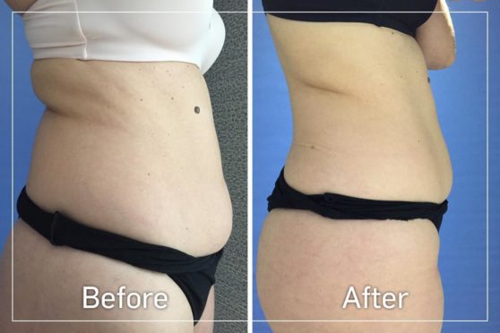 LPG Body Contouring: This patient had eight LPG Body Contouring sessions. She actually gained weight over the course of treatment and yet still achieved these amazing results.