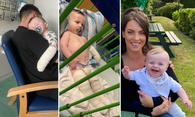 Baby Blake Nilssen was left with serious burns after the incident at his Aberdeen nursery