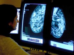 Women who received one false positive result after a mammogram are two times as likely to develop breast cancer, a study has said (Rui Vieira/PA)