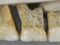 The right upper teeth of the individual CCH6 of the newly discovered species Homo luzonensis (Callao Cave Archaeology Project via AP)