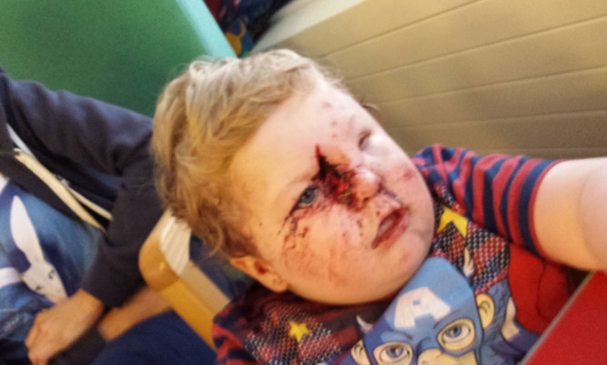 Two-year-old Ollie Cummings with the horrific injuries sustained after a dog attack.