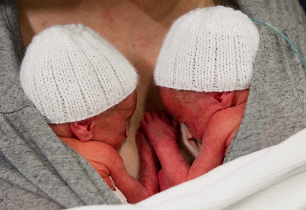 The twins just after they were born
