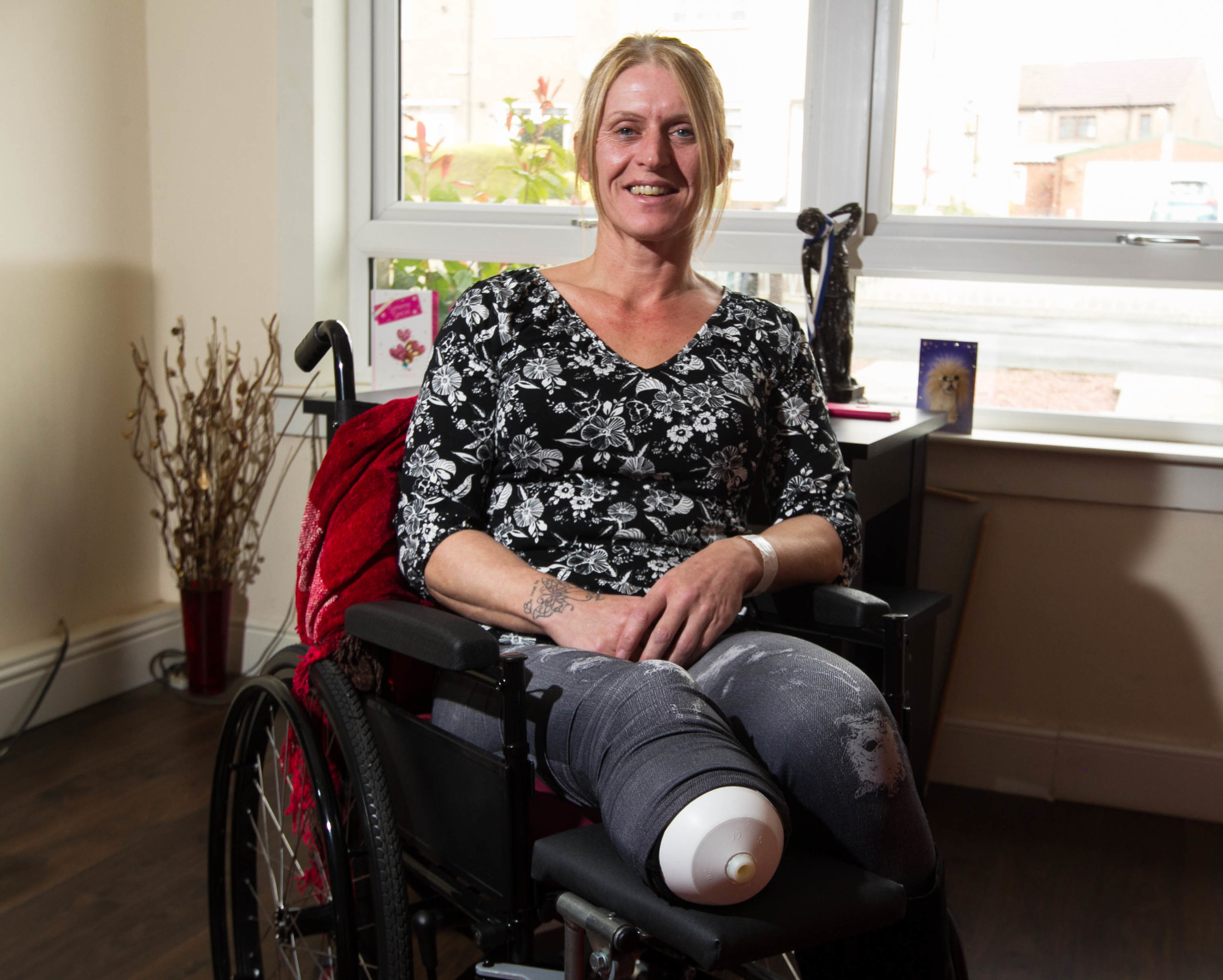 Lesley Ravencroft lost her right leg after doctors couldn’t fix a blocked artery (Chris Austin/ DC Thomson)