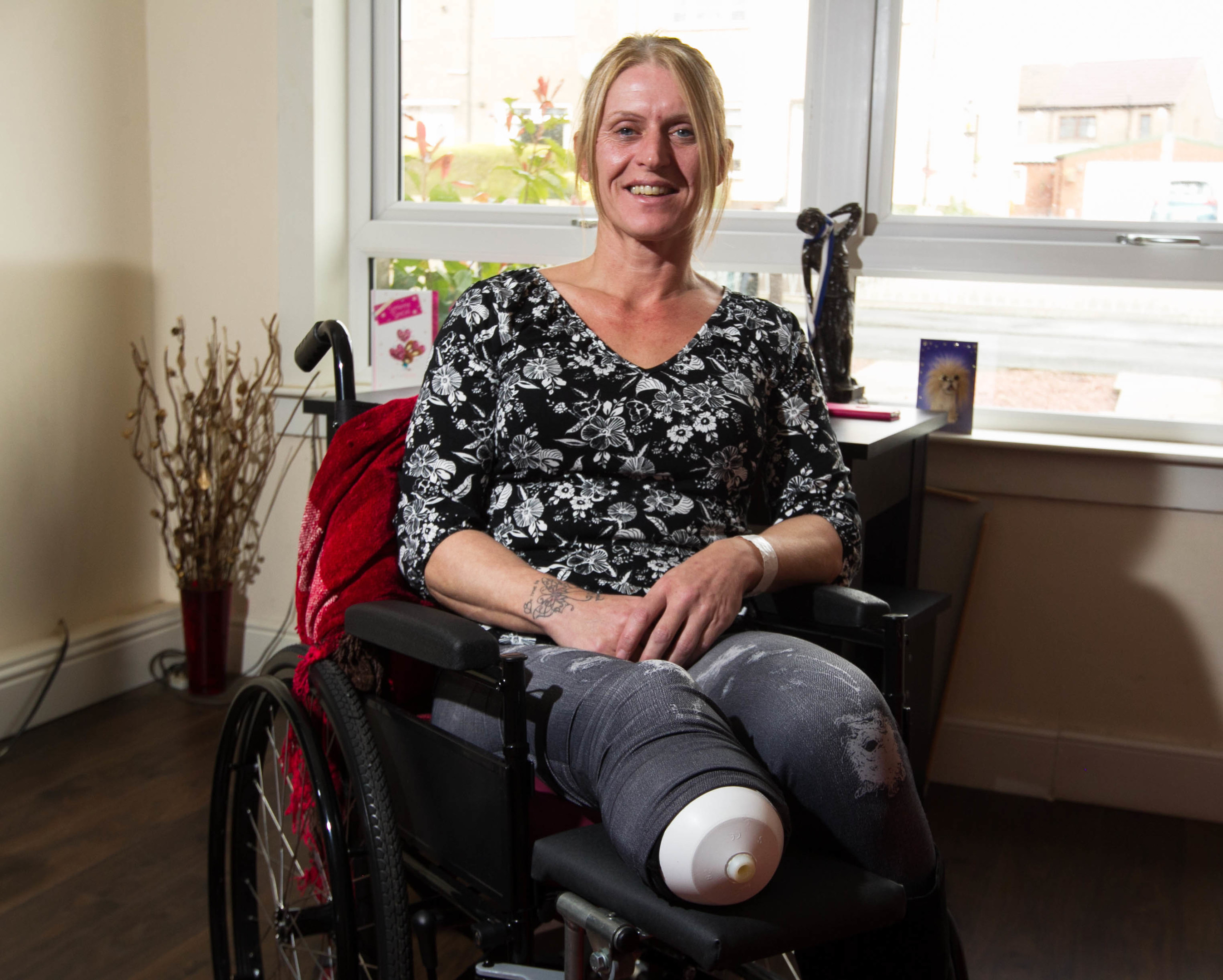 Bionic Leg For Bodybuilder Mum