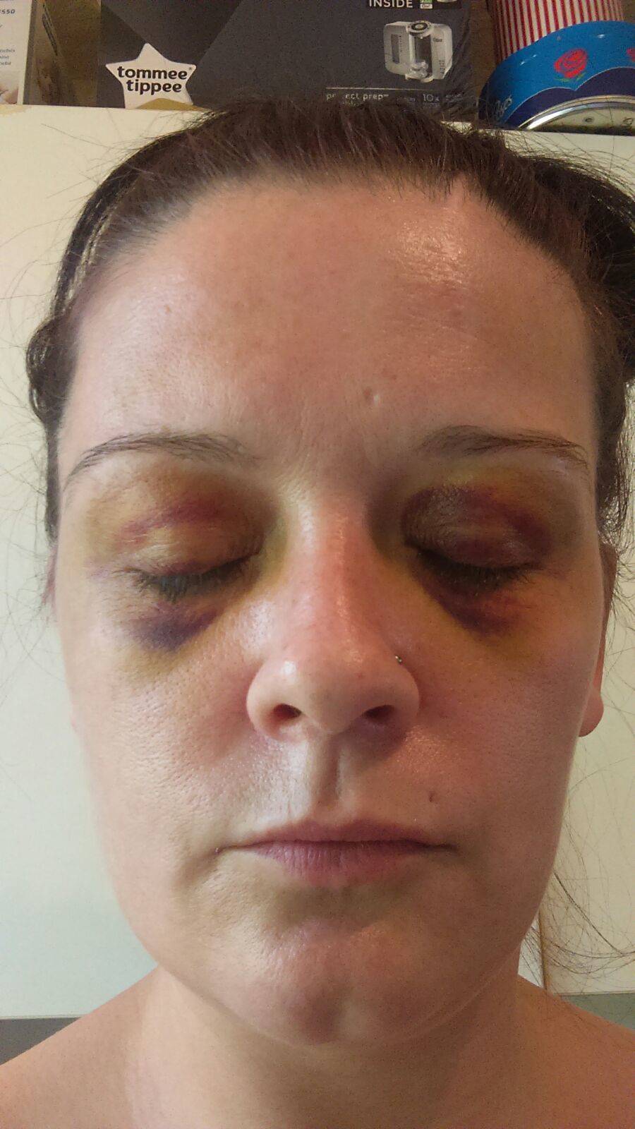 Donna Speirs, 33, after she was beaten up by partner Myles Leyden, 27, from Greenock 