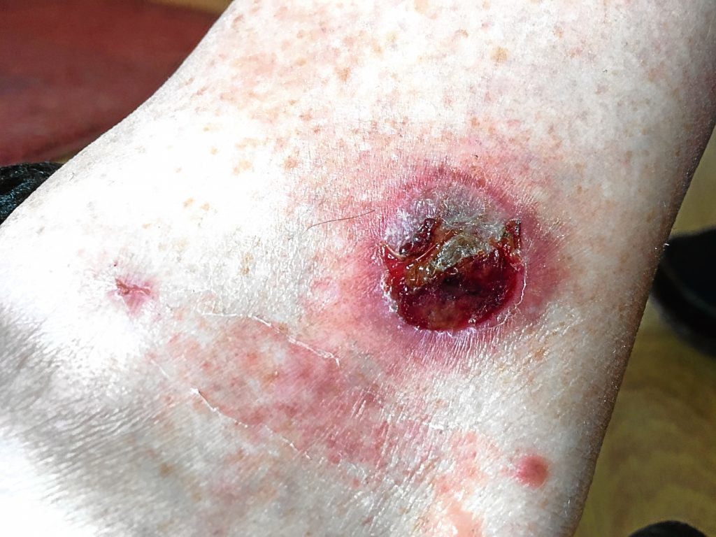 The spider bite on Robert Gray's ankle