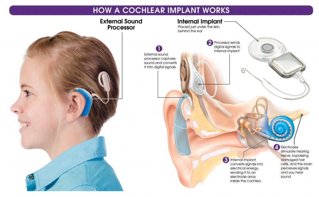 How the ear implant works 