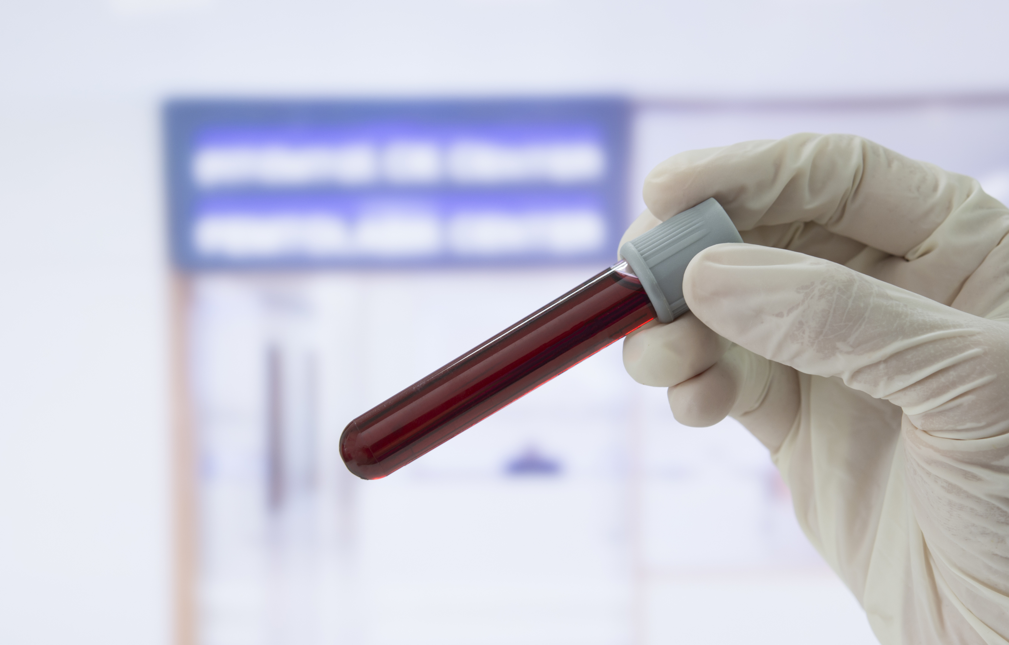 A simple blood test has been developed that detects aggressive and potentially lethal prostate cancer by identifying rare free-ranging tumour cells (iStock)