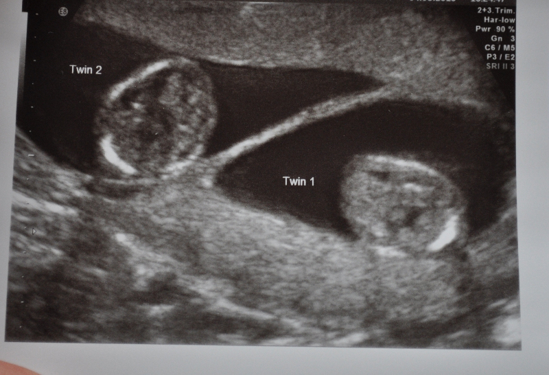 A scan of the record-breaking twins