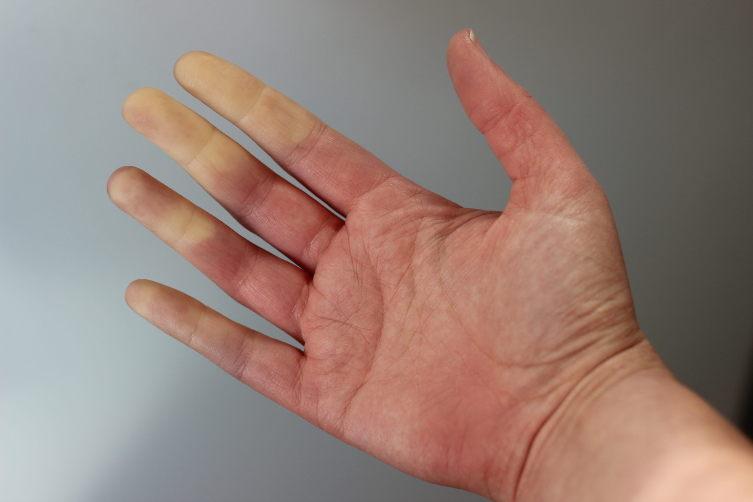 Raynaud’s is a condition that affects blood circulation causing some areas of the body, such as fingers and toes, to feel painfully numb or freezing cold in response to changes in temperature