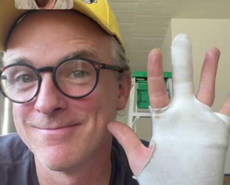 Fran Healy after his hand was mauled by a dog.