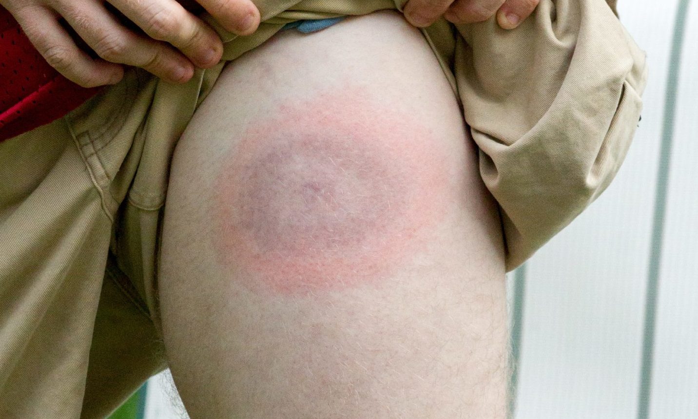 Tick bites can create a rash which looks like a "bullseye"