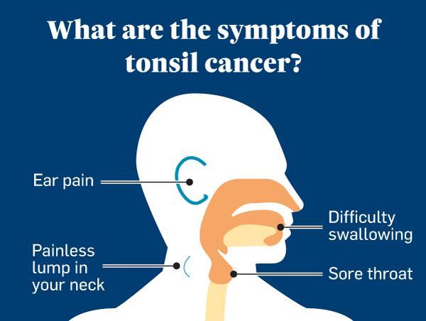 Symptoms of tonsil cancer graphic
