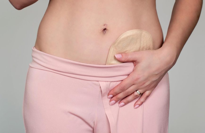 A person touching the stoma area