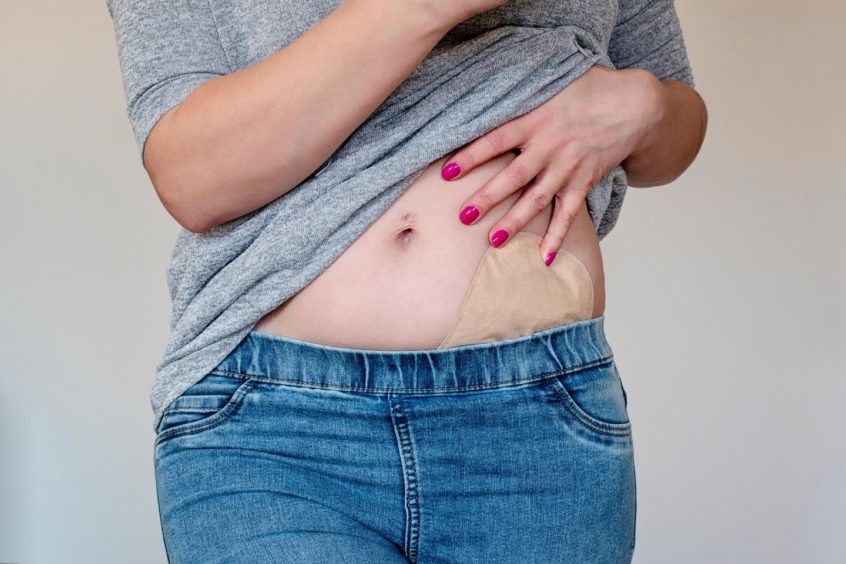 A person pulling up a t-shirt to reveal a colostomy bag under jeans
